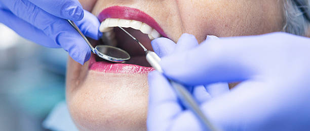 Best Knocked-Out Tooth (Avulsed Tooth) Treatment in Brewster, NY